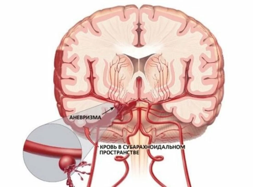 The Connection between Subarachnoid Hemorrhage and Aneurysms: A Closer Look