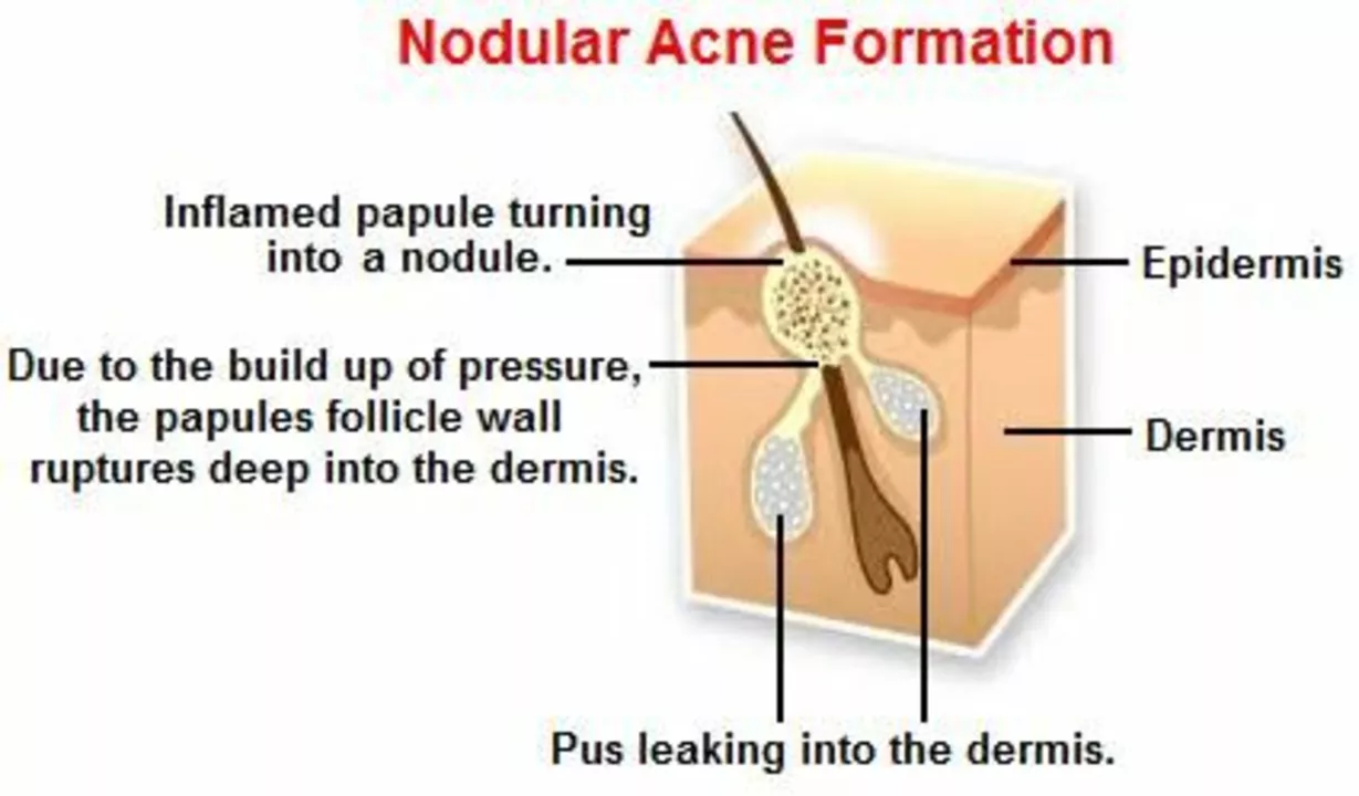 The Role of Hydration in Nodular Acne Prevention and Management